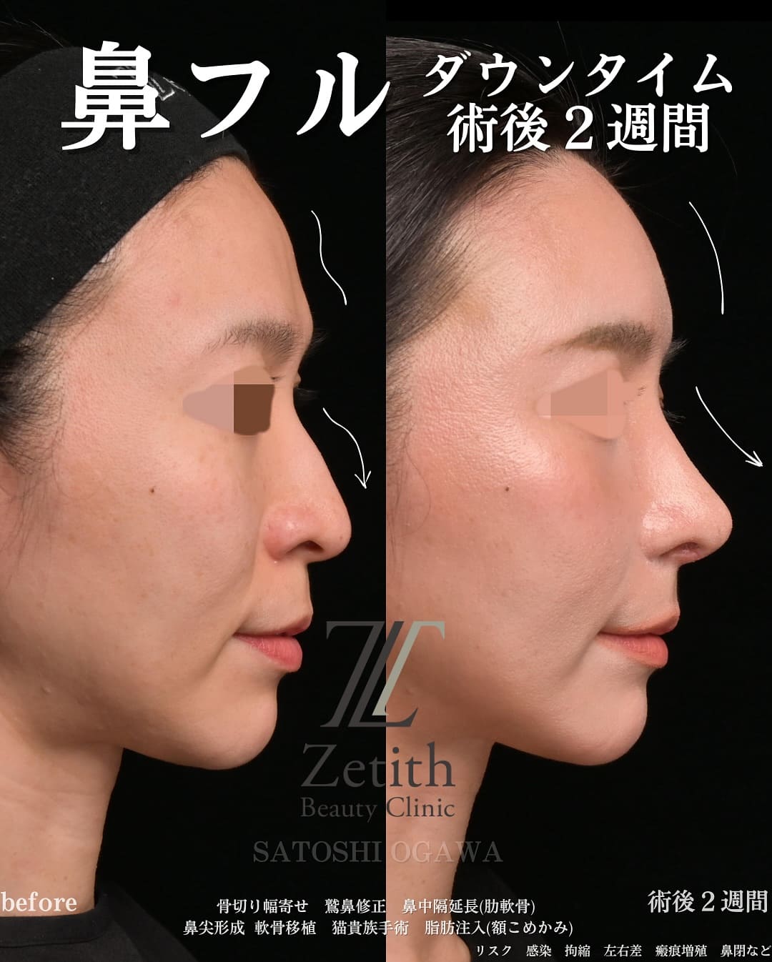 小川医師による鼻整形の術前/術後2週間 术后 