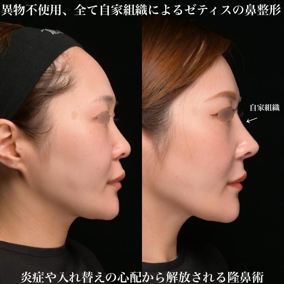 鉄医師による鼻整形の術前/術後6ヶ月 After 