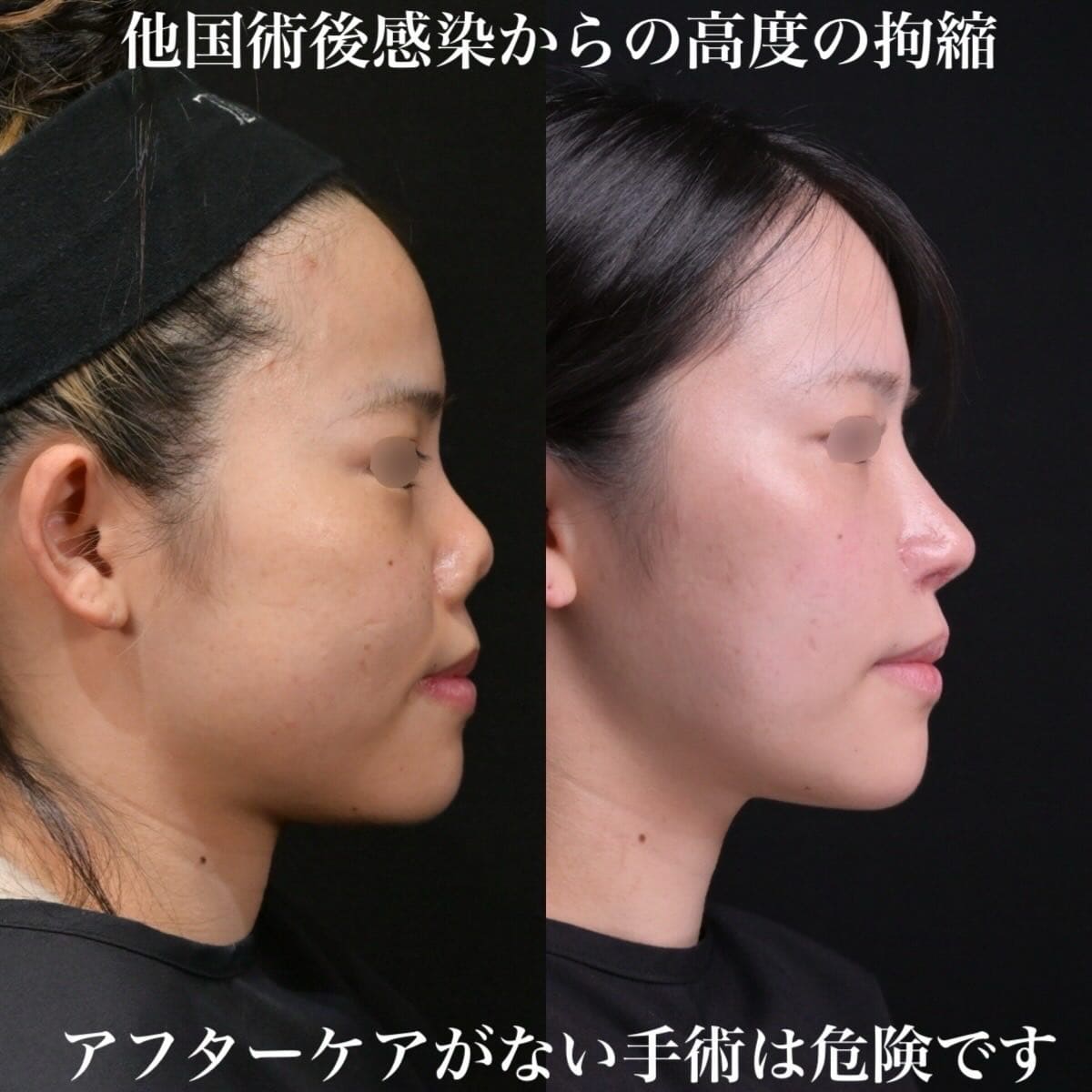 鉄医師による鼻整形の術前/術後2年 术后 