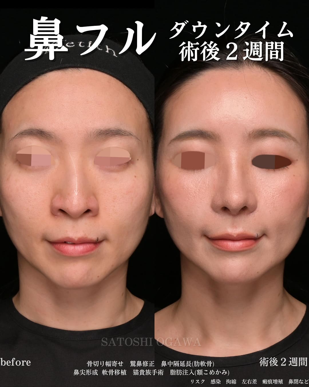 小川医師による鼻整形の術前/術後2週間