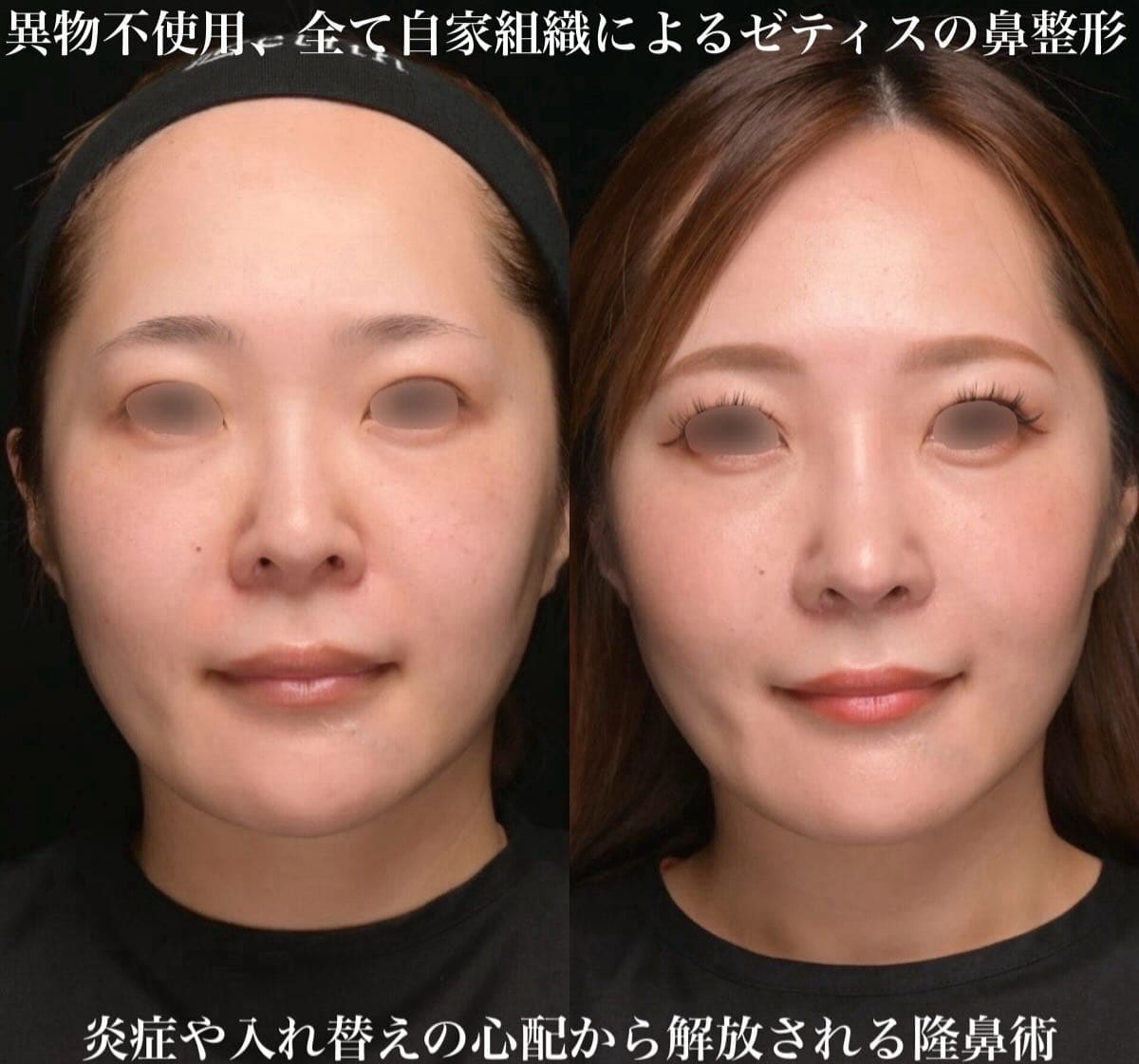 鉄医師による鼻整形の術前/術後6ヶ月