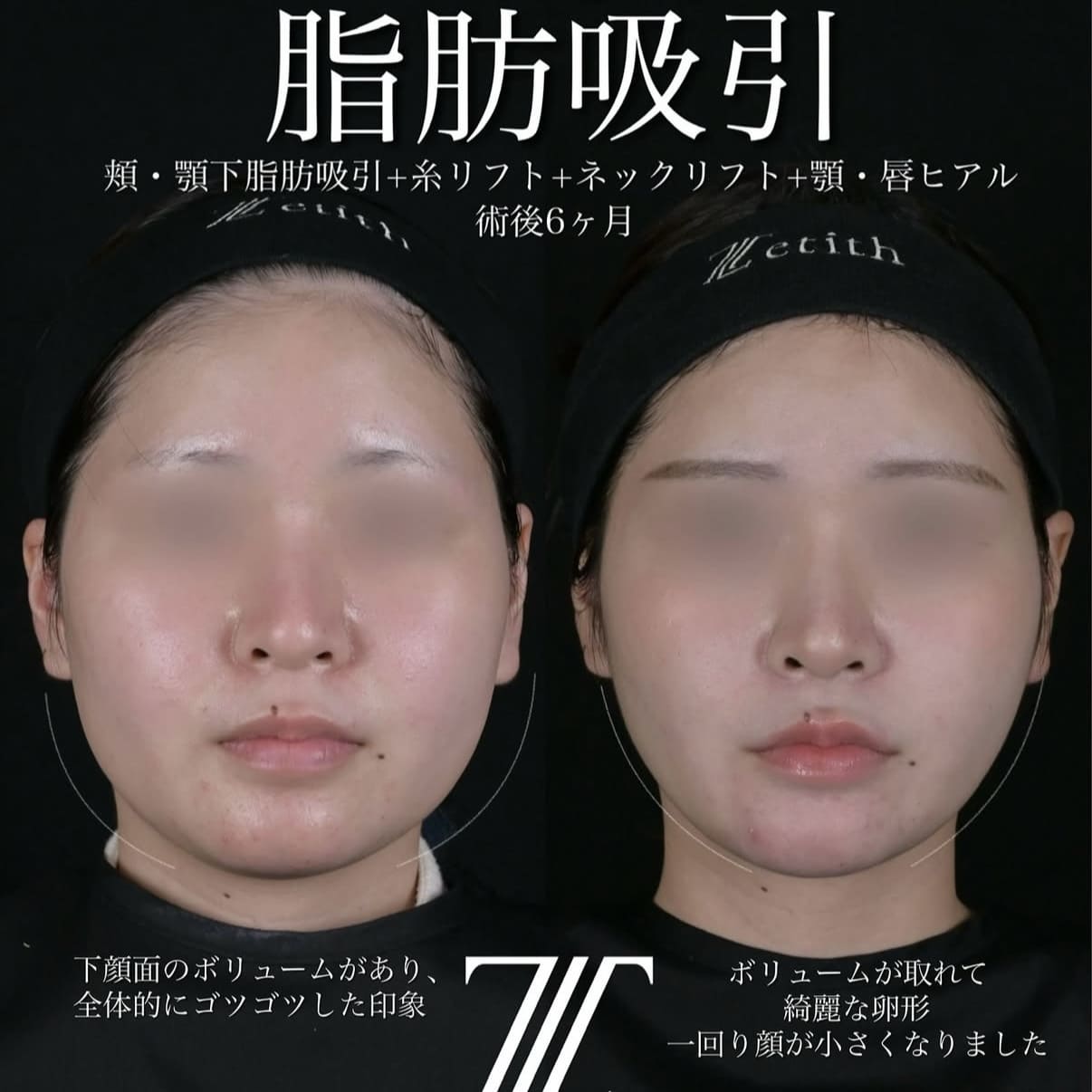 北村医師による脂肪吸引リフト術前/術後6ヶ月 After 
