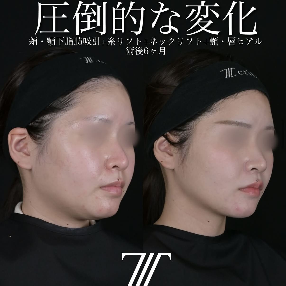 北村医師による脂肪吸引リフト術前/術後6ヶ月