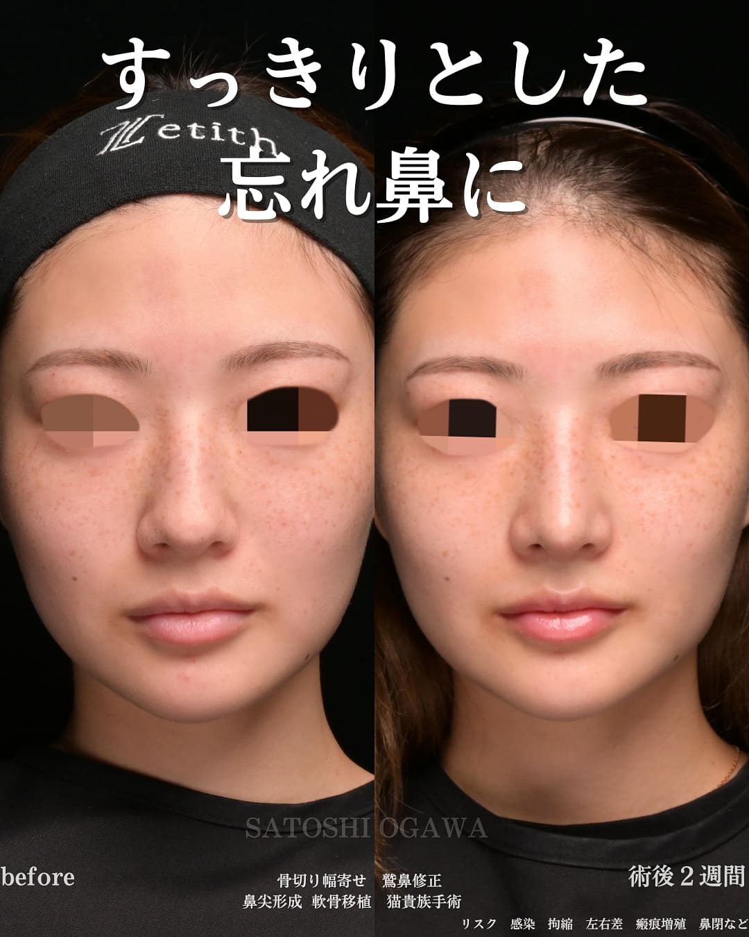 小川医師による鼻整形の術前/術後2週間