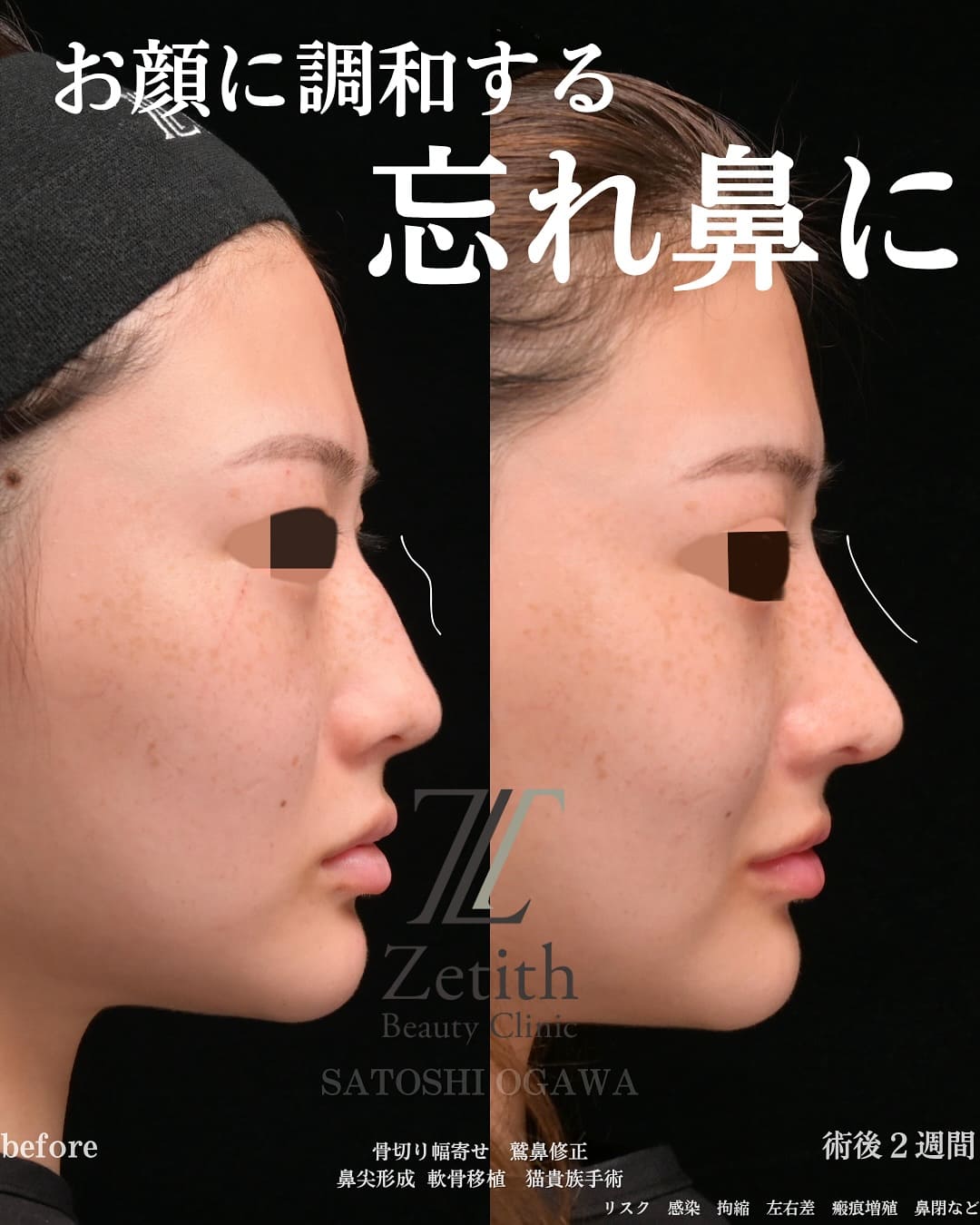 小川医師による鼻整形の術前/術後2週間 施術後 