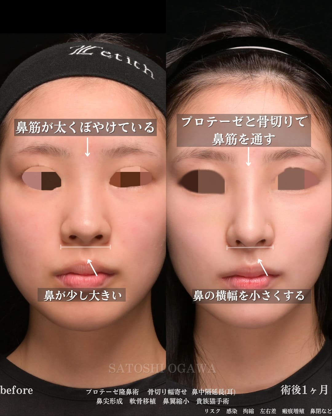 小川医師による鼻整形の術前/術後1ヶ月
