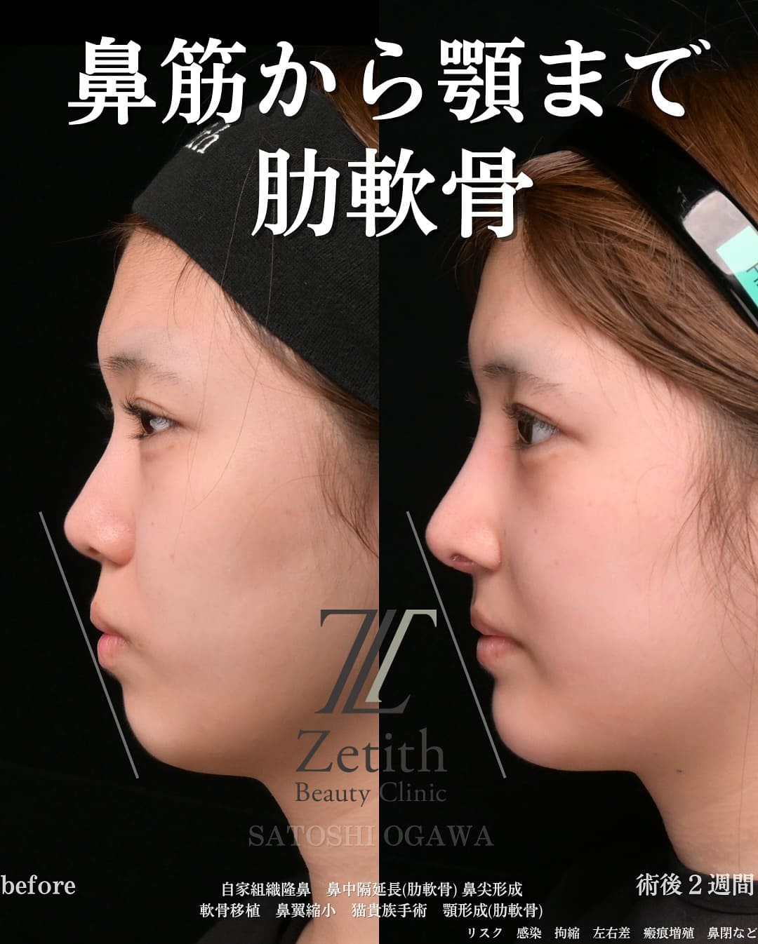 小川医師による鼻整形の術前/術後2週間 术后 