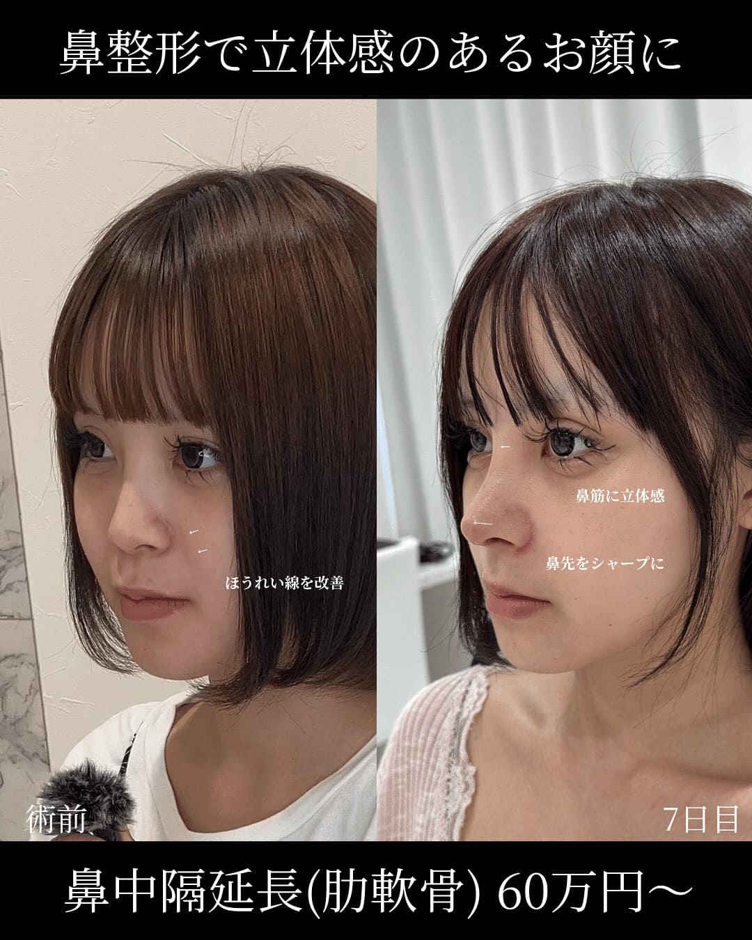 羽根医師による鼻整形の術前/抜糸直後