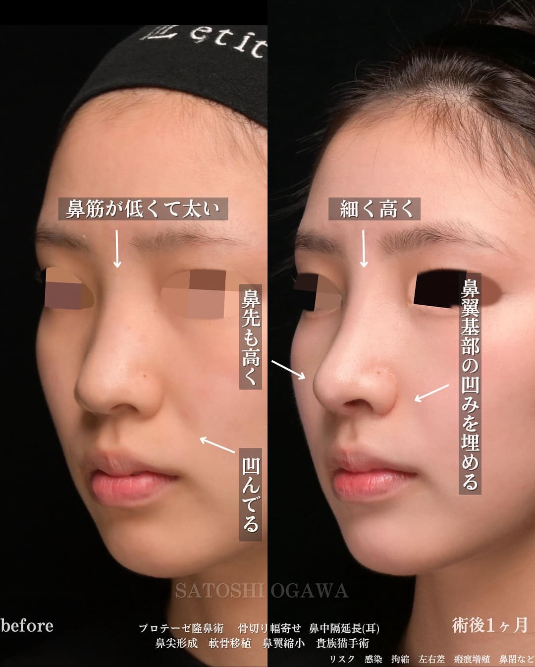 小川医師による鼻整形の術前/術後1ヶ月 施術後 