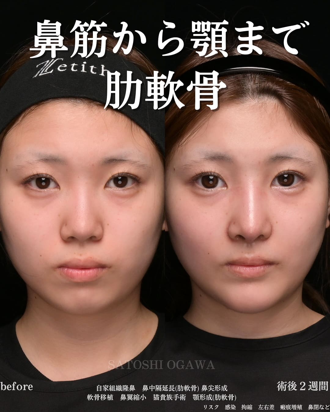 小川医師による鼻整形の術前/術後2週間