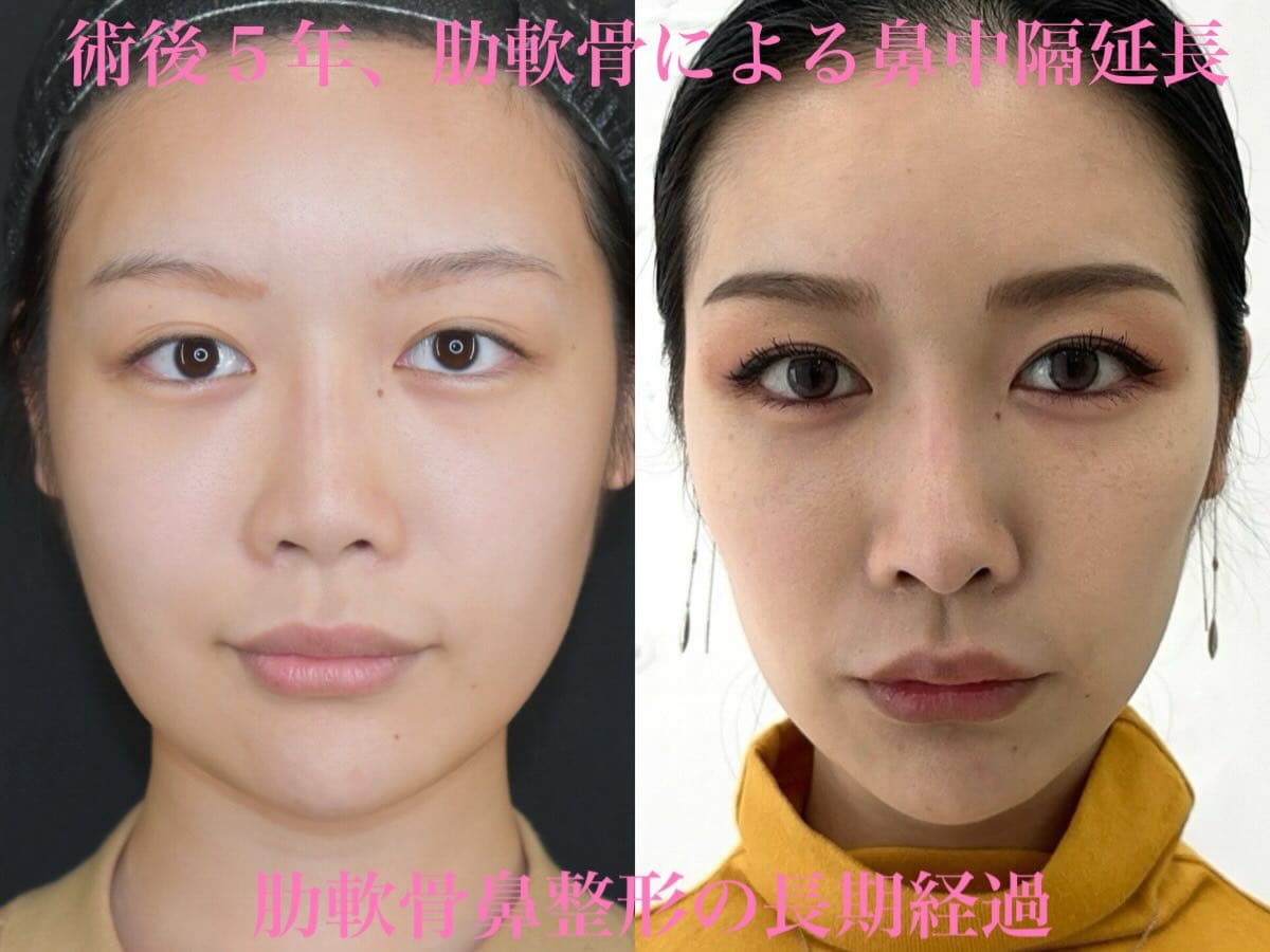 鉄 医師による鼻整形の術前/術後5年