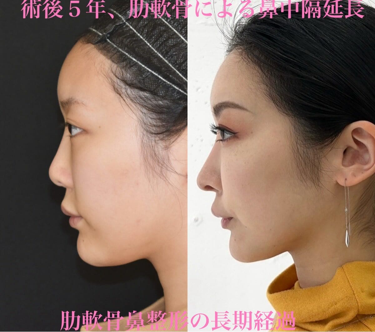 鉄 医師による鼻整形の術前/術後5年 术后 