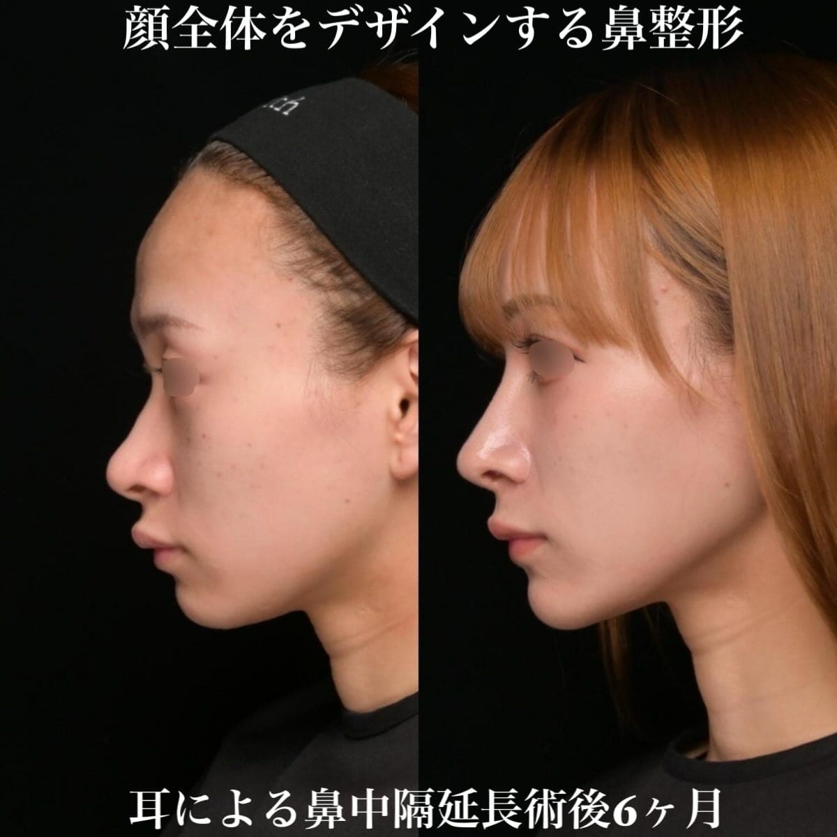 鉄　医師による鼻整形の術前/術後6ヶ月 Дараа 