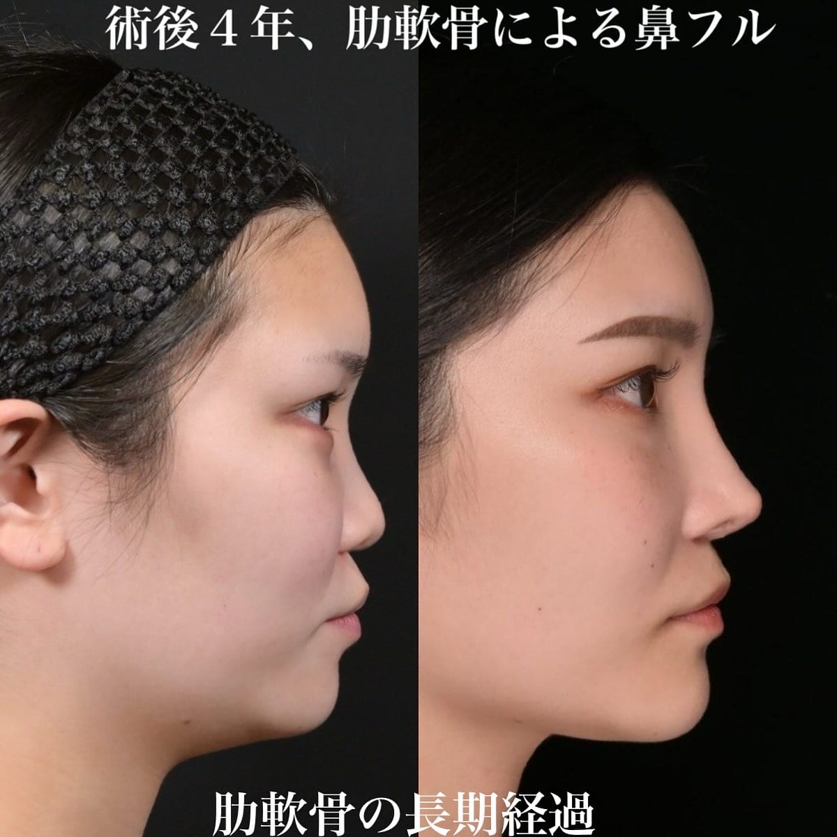 鉄医師による鼻整形の術前/術後4年 After 