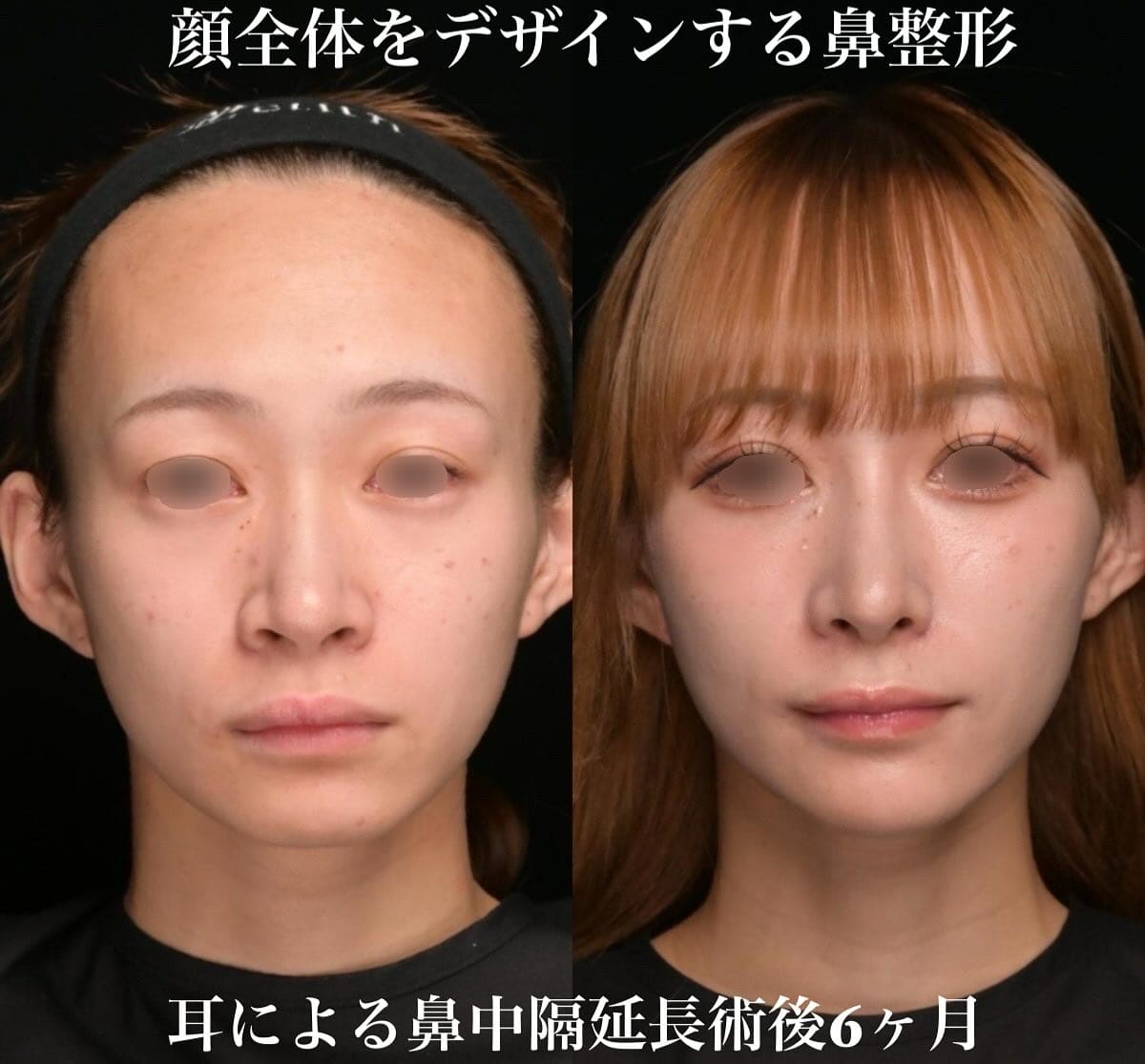 鉄　医師による鼻整形の術前/術後6ヶ月