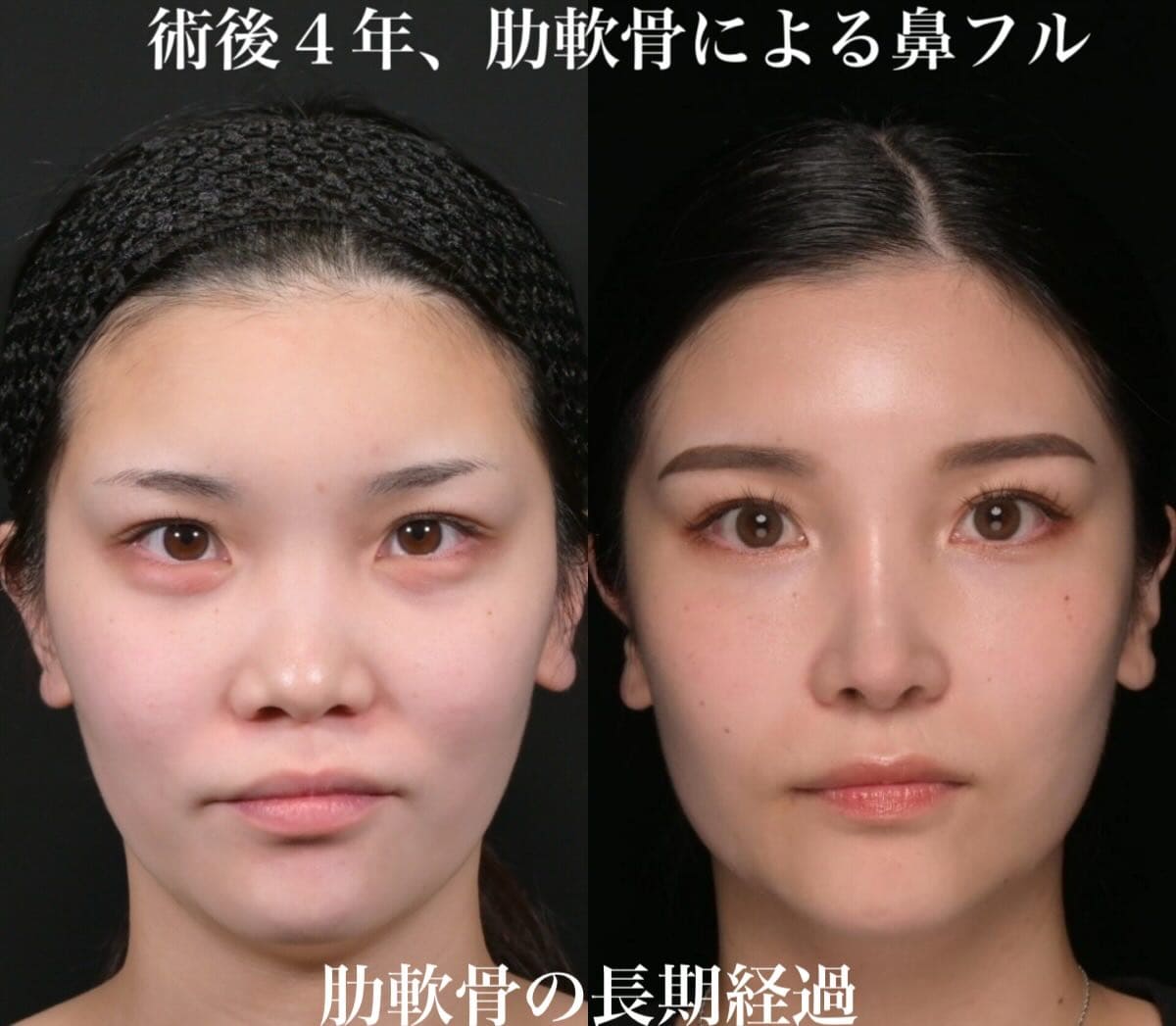 鉄医師による鼻整形の術前/術後4年