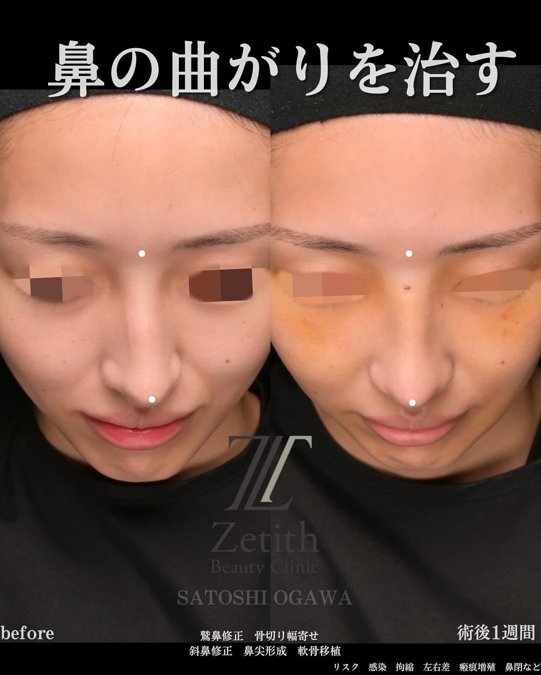 小川医師による鼻整形の術前/術後1週間