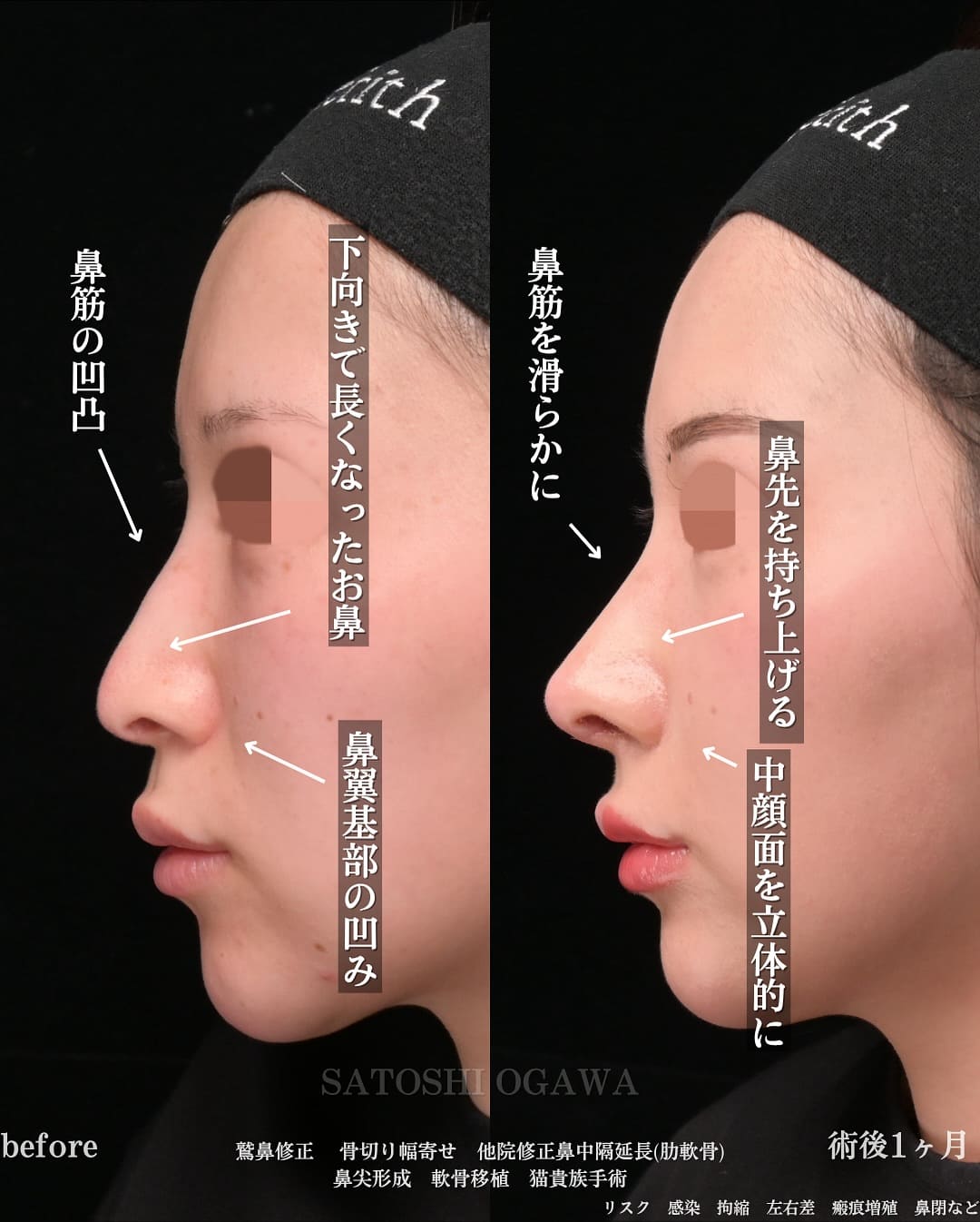 小川医師による鼻整形の術前/術後1ヶ月
