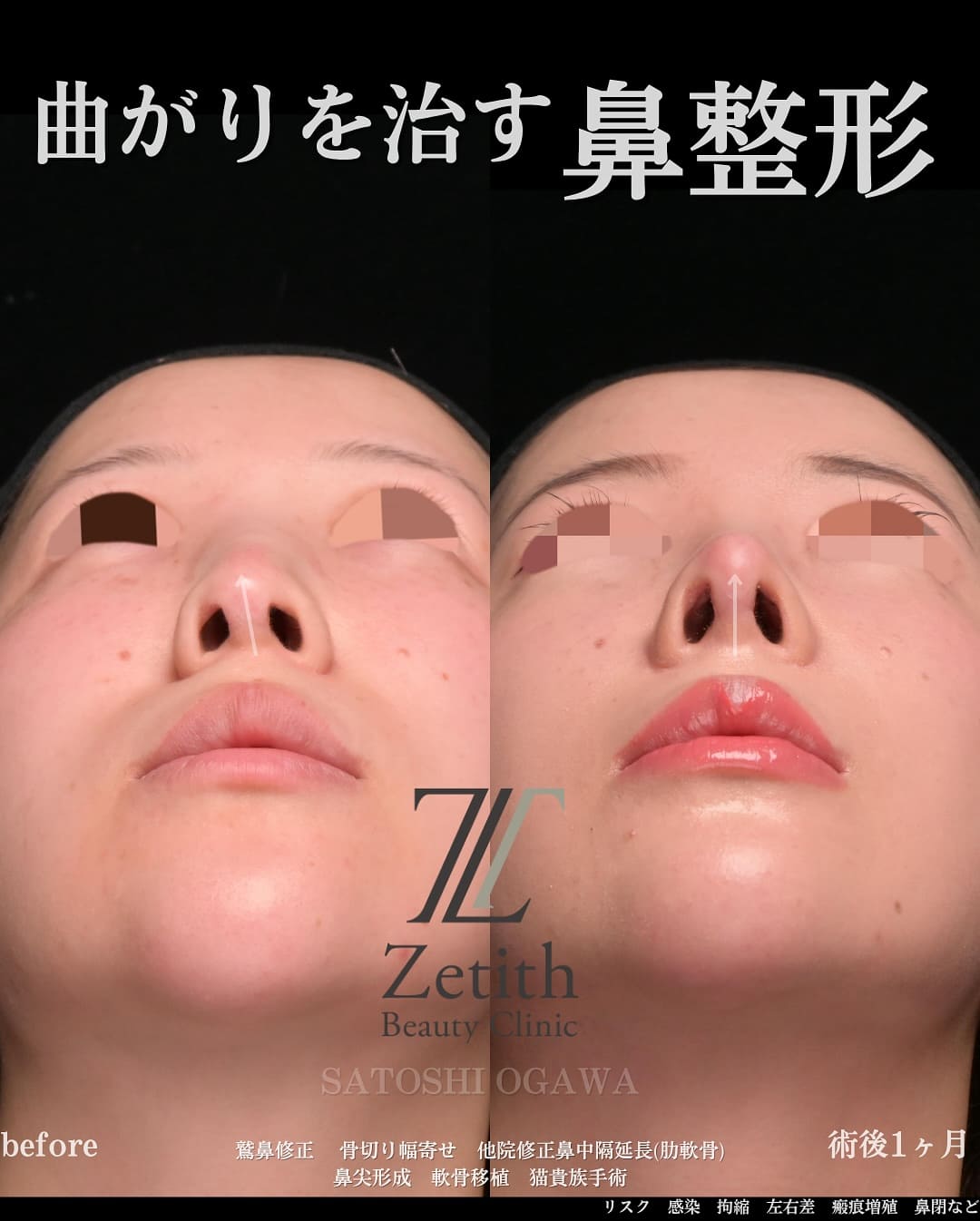 小川医師による鼻整形の術前/術後1ヶ月 Дараа 