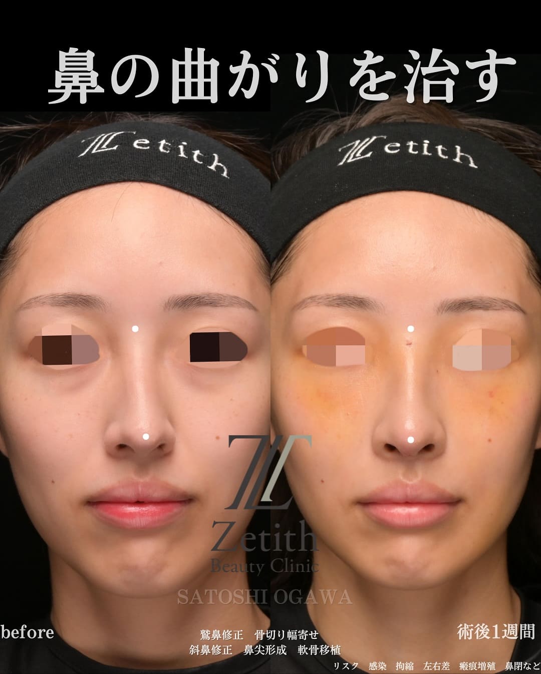 小川医師による鼻整形の術前/術後1週間 หลัง 