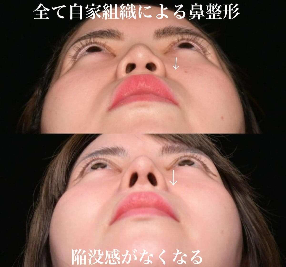 鉄医師による鼻整形の術前/術後6ヶ月 After 