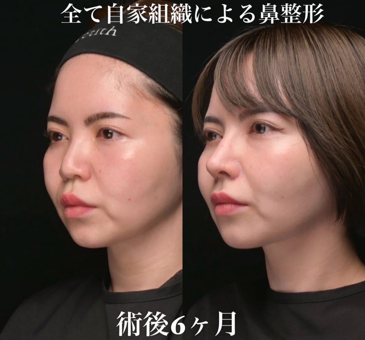 Nose | By Concern — Zetith Beauty Clinic