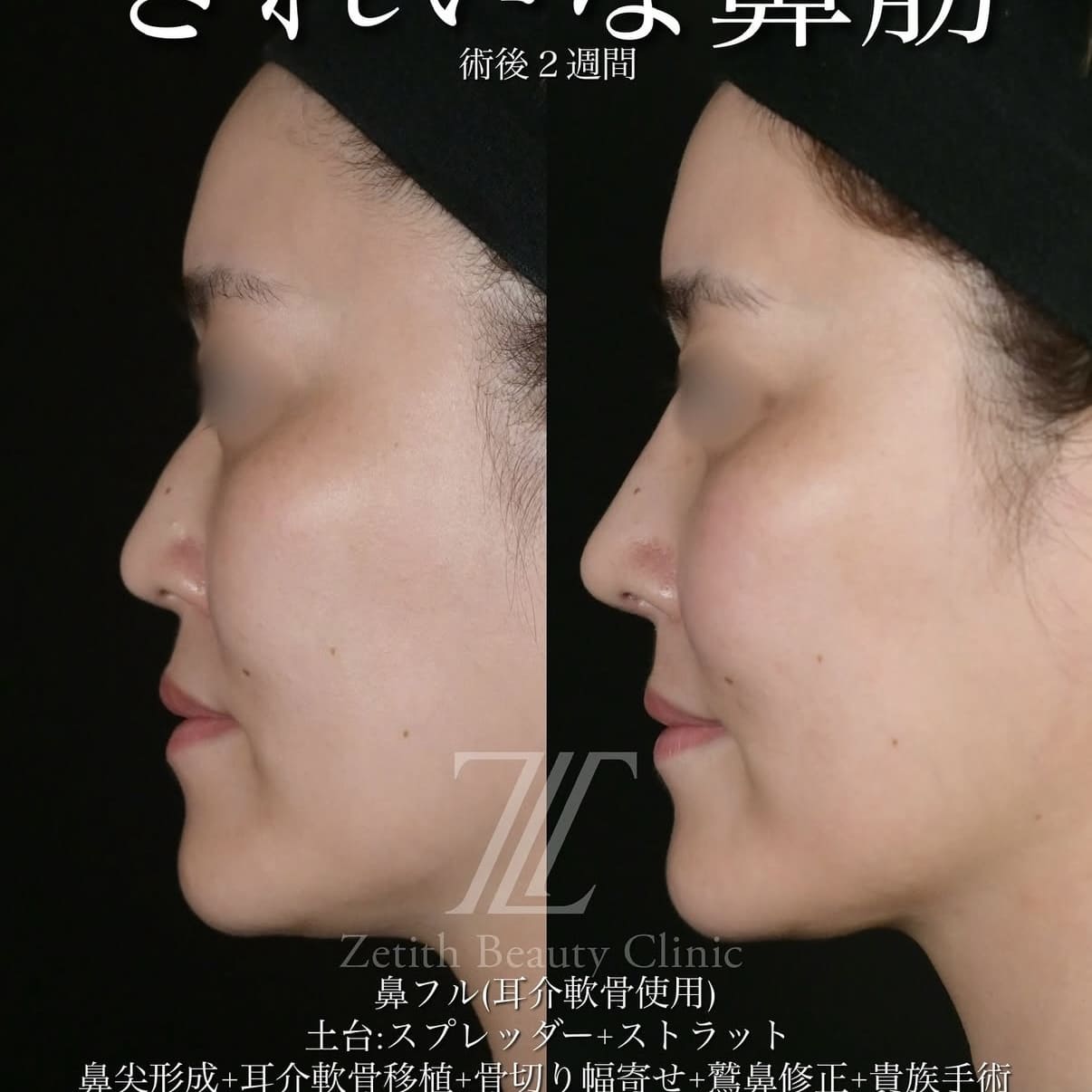 北村医師による鼻整形術前/術後2週間 Дараа 