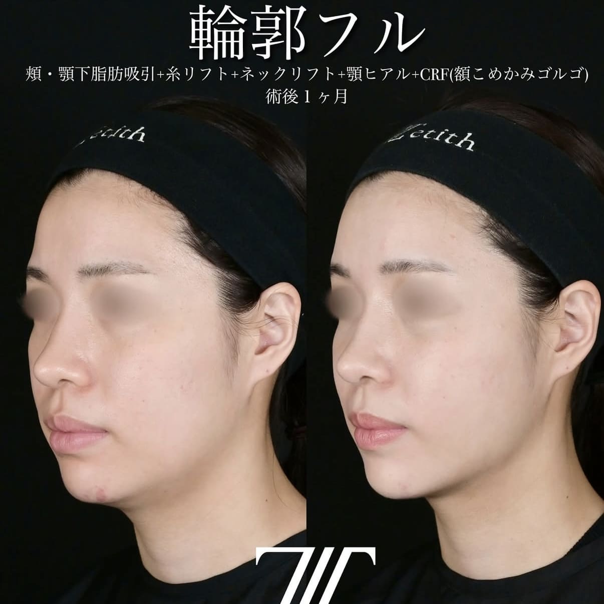 症例写真