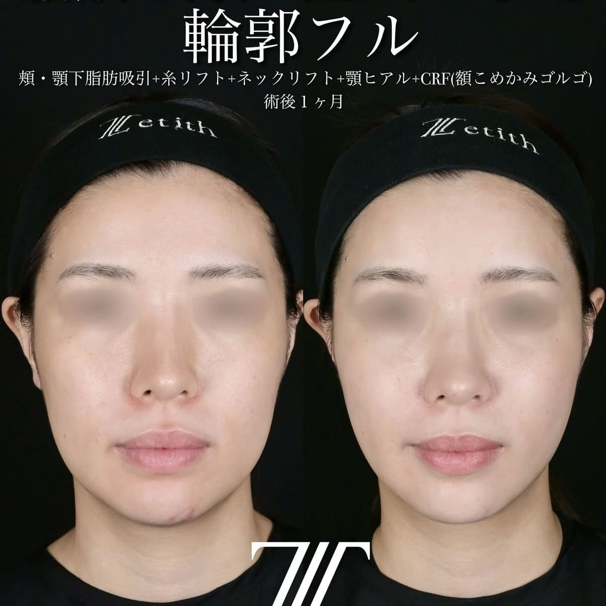症例写真