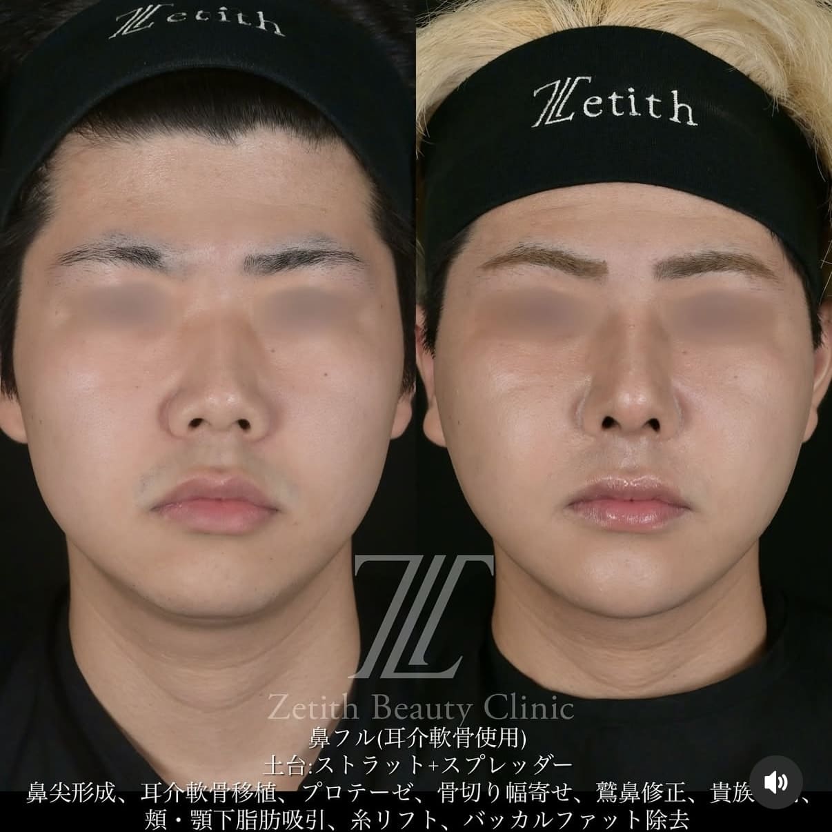 北村医師による鼻整形と脂肪吸引リフト術前/術後1ヶ月