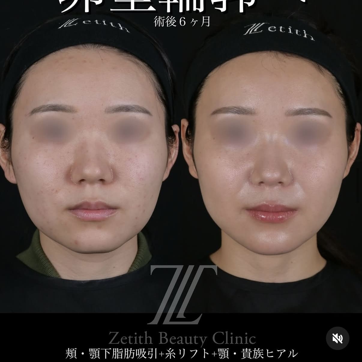 症例写真