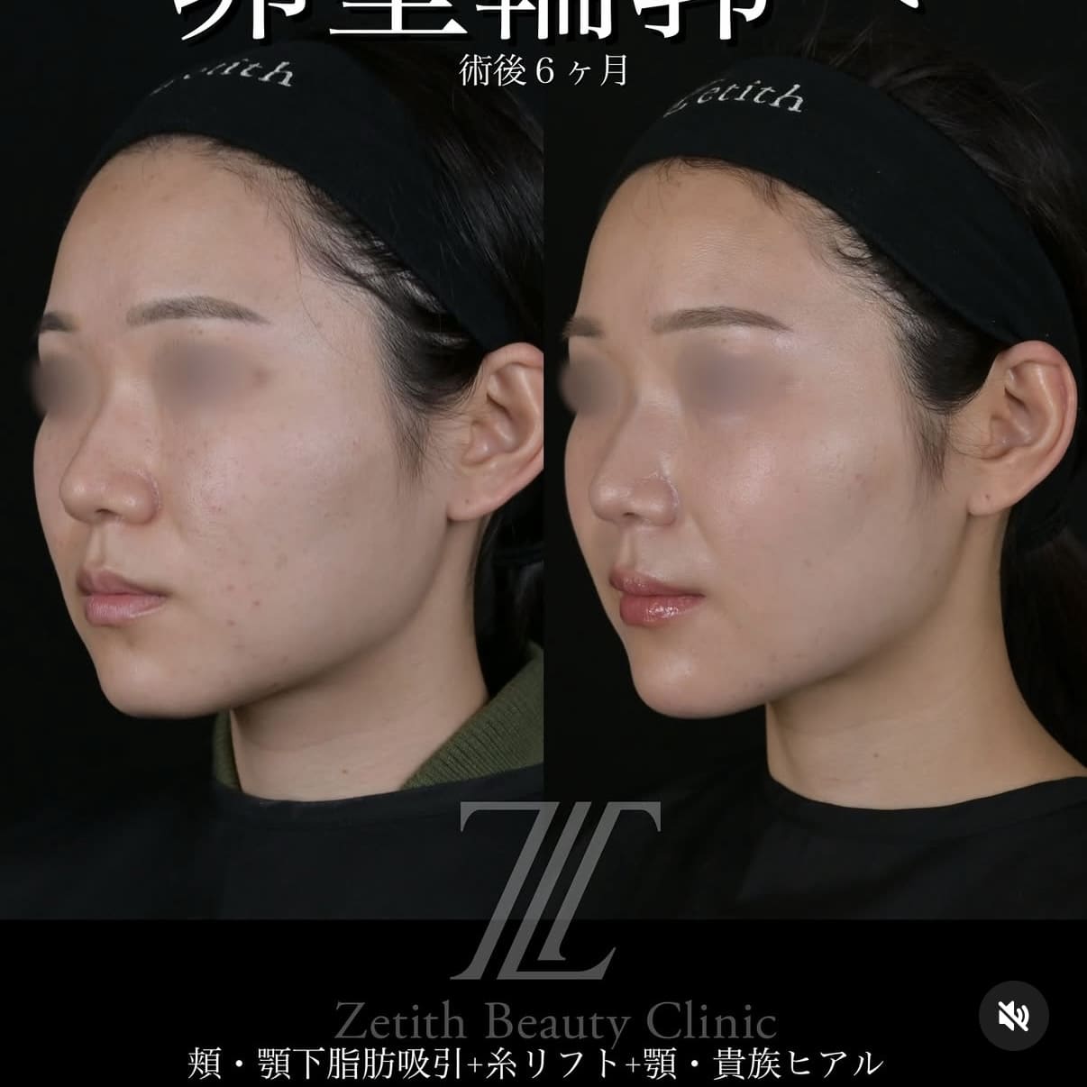症例写真