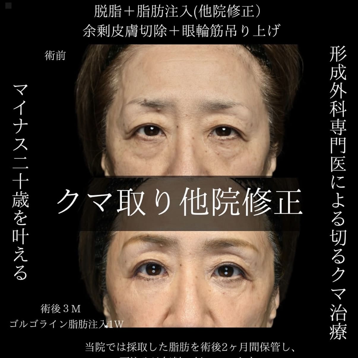副島医師によるクマ治療術前/術後3ヶ月