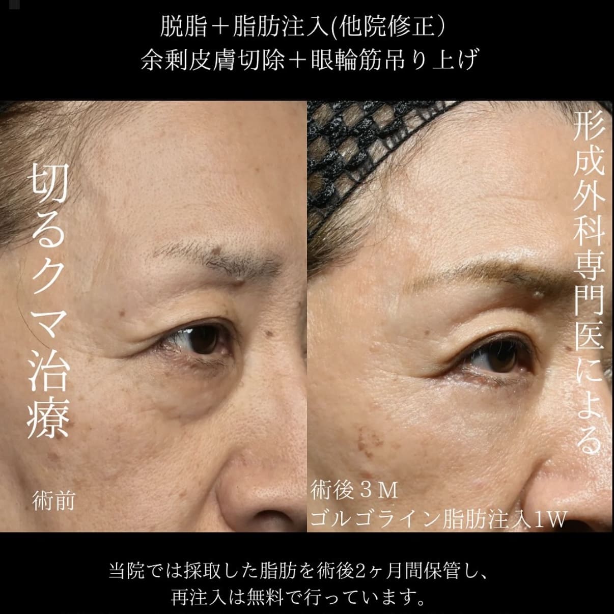 副島医師によるクマ治療術前/術後3ヶ月 After 