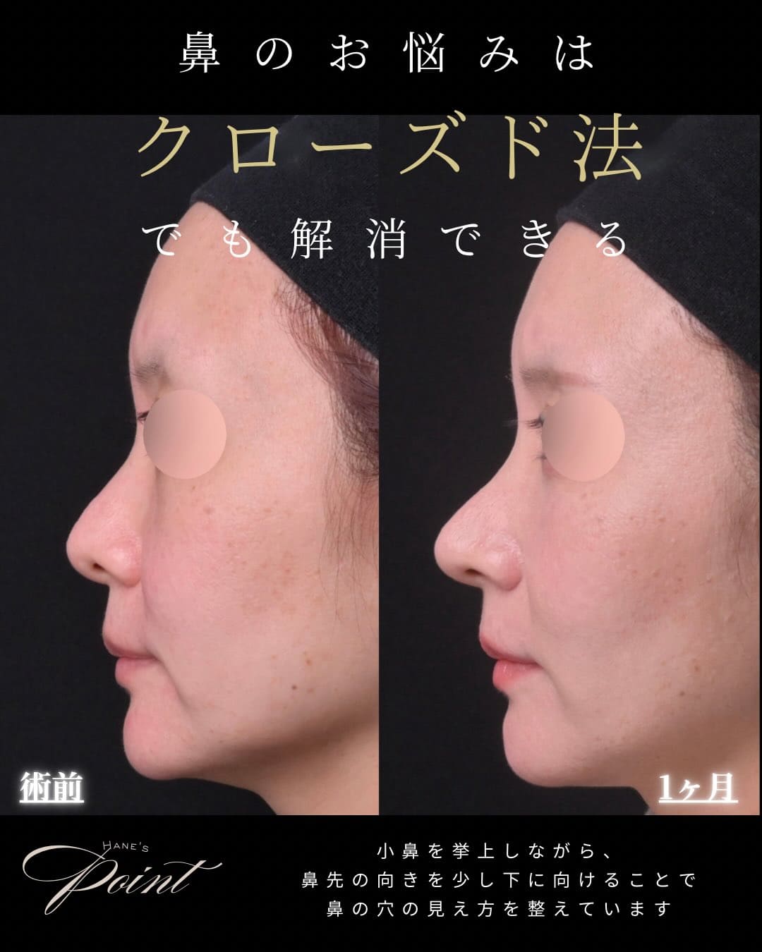 羽根医師による鼻整形の術前/術後1ヶ月 施術後 