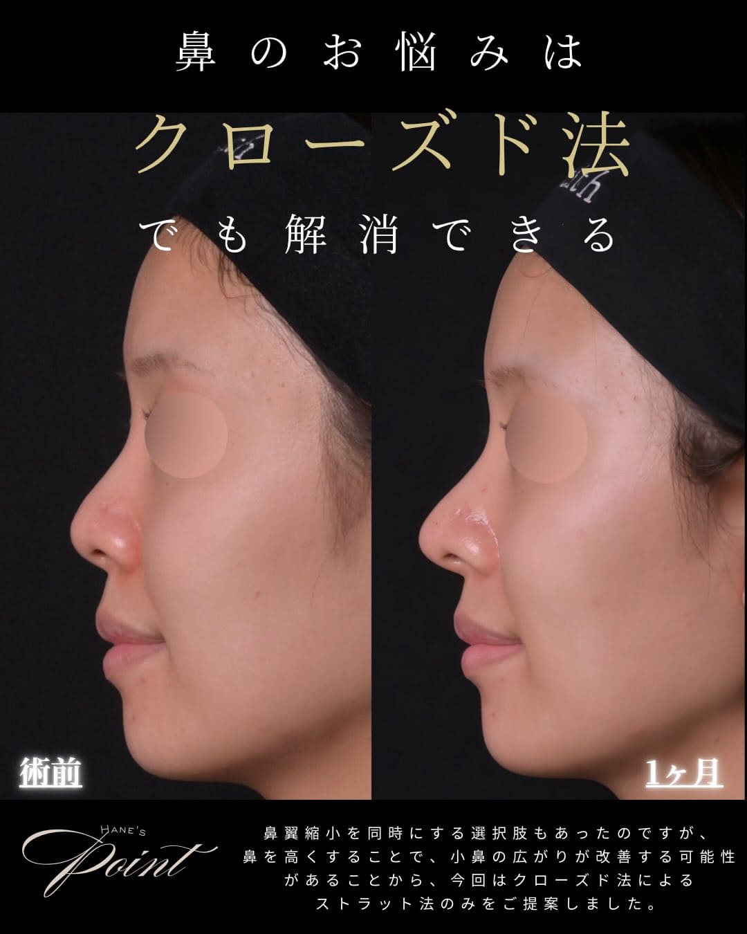 羽根医師による鼻整形の術前/術後1週間