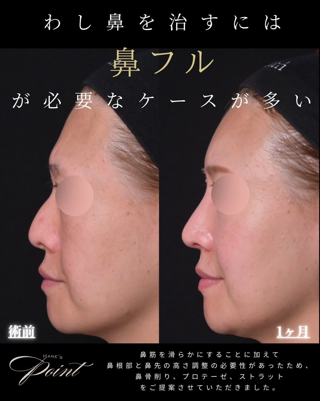 羽根医師による鼻整形の術前/術後1ヶ月 Sau 