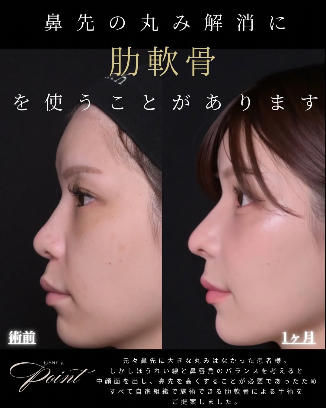羽根医師による鼻整形の術前/術後1ヶ月