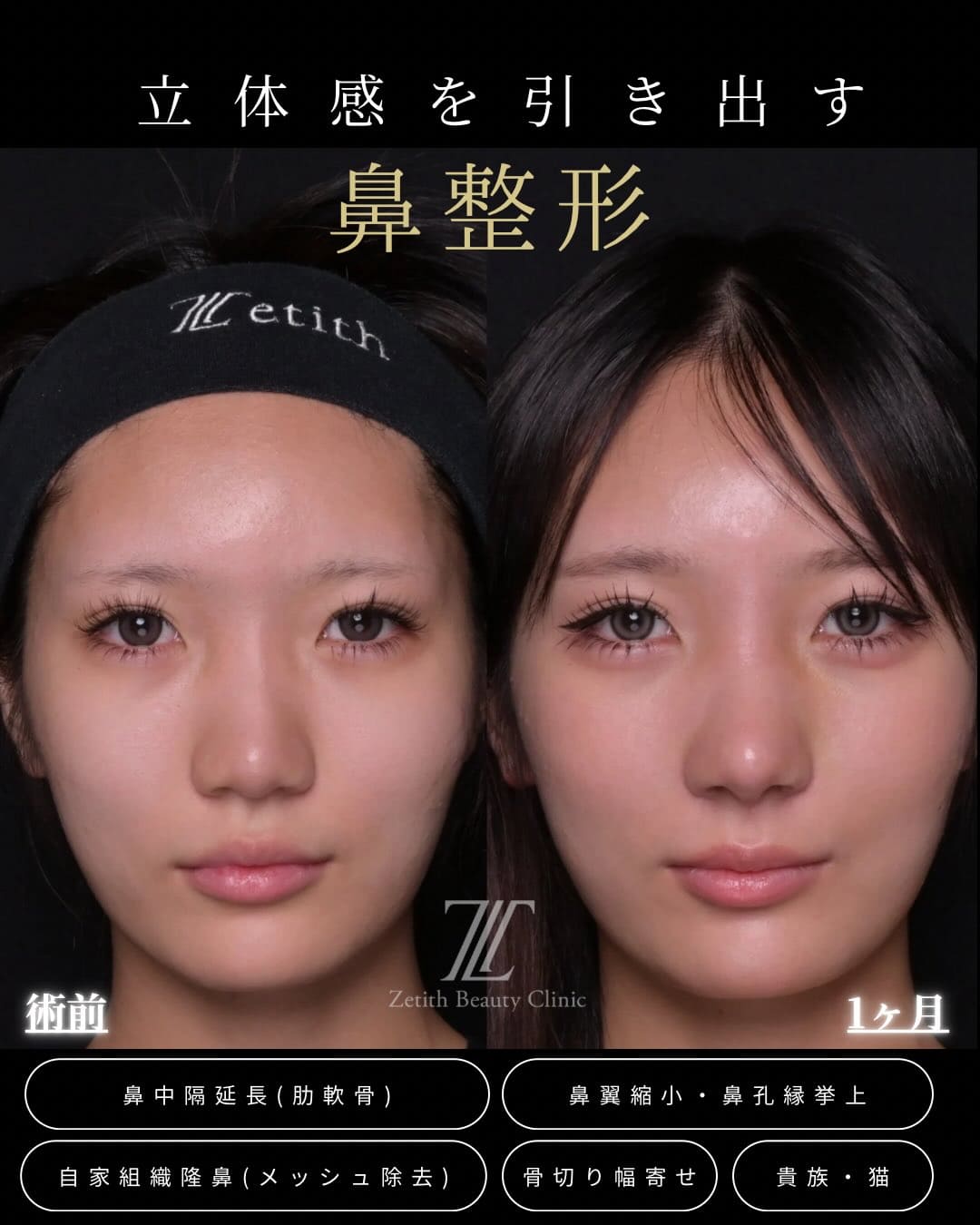 羽根医師による鼻整形の術前/術後1ヶ月