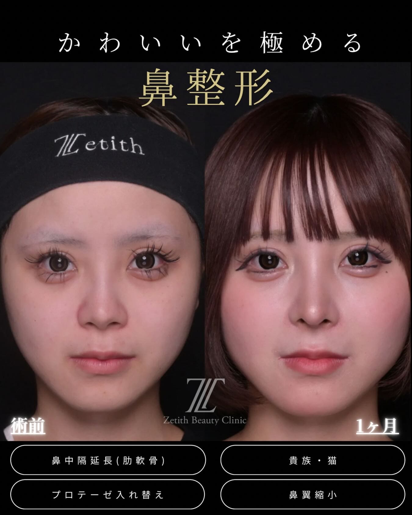 羽根医師による鼻整形の術前/術後1ヶ月