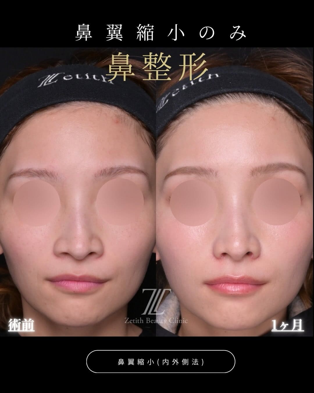 羽根医師による鼻整形の術前/術後1ヶ月