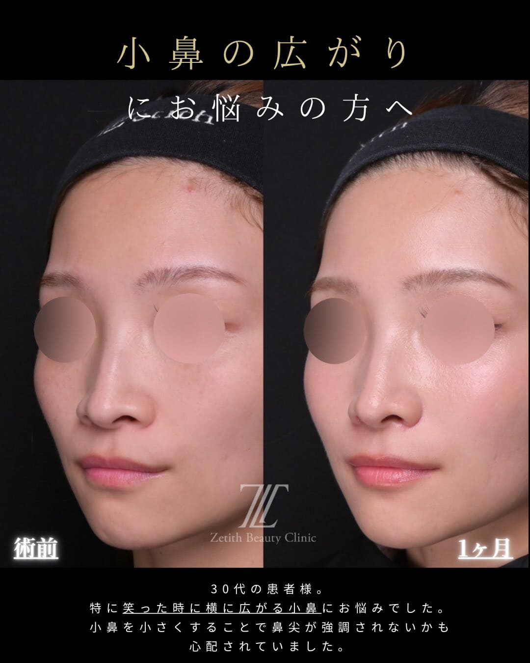 羽根医師による鼻整形の術前/術後1ヶ月 术后 