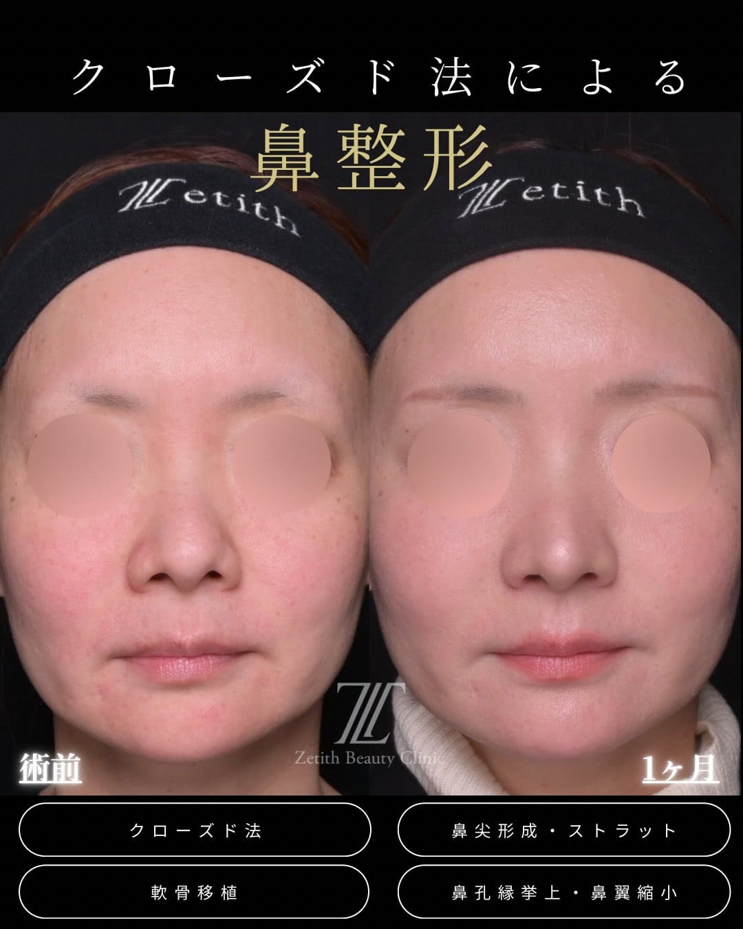 羽根医師による鼻整形の術前/術後1ヶ月