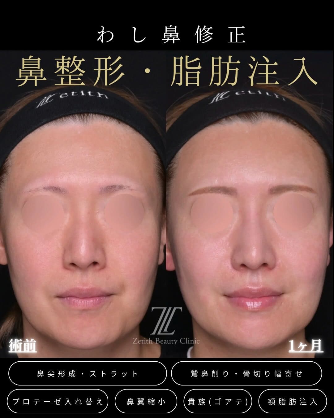 羽根医師による鼻整形の術前/術後1ヶ月