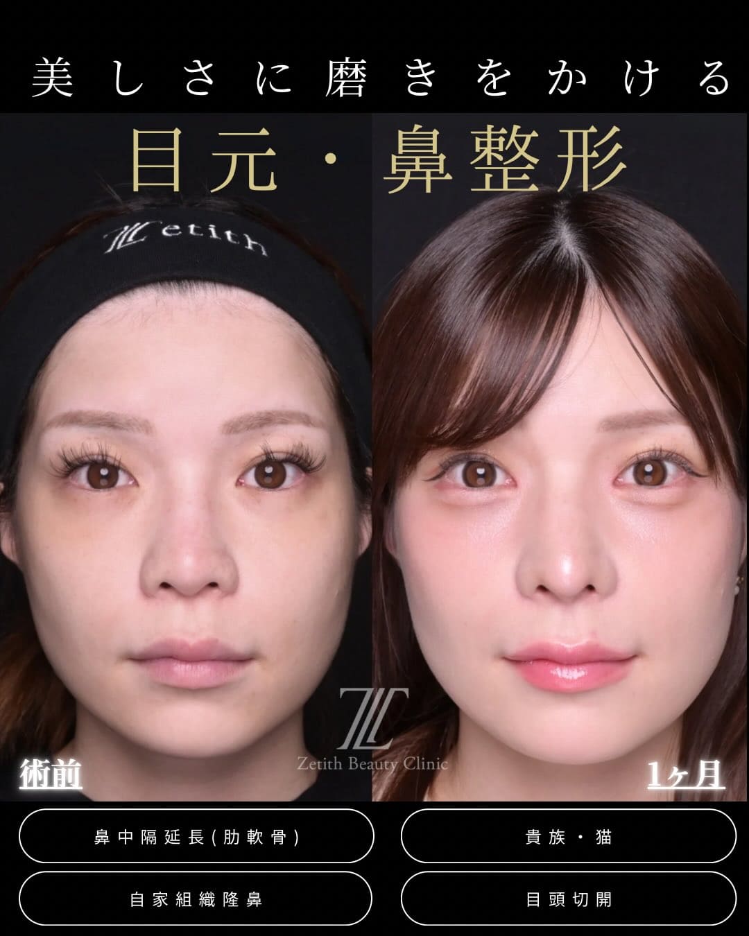 羽根医師による鼻整形の術前/術後1ヶ月 施術後 