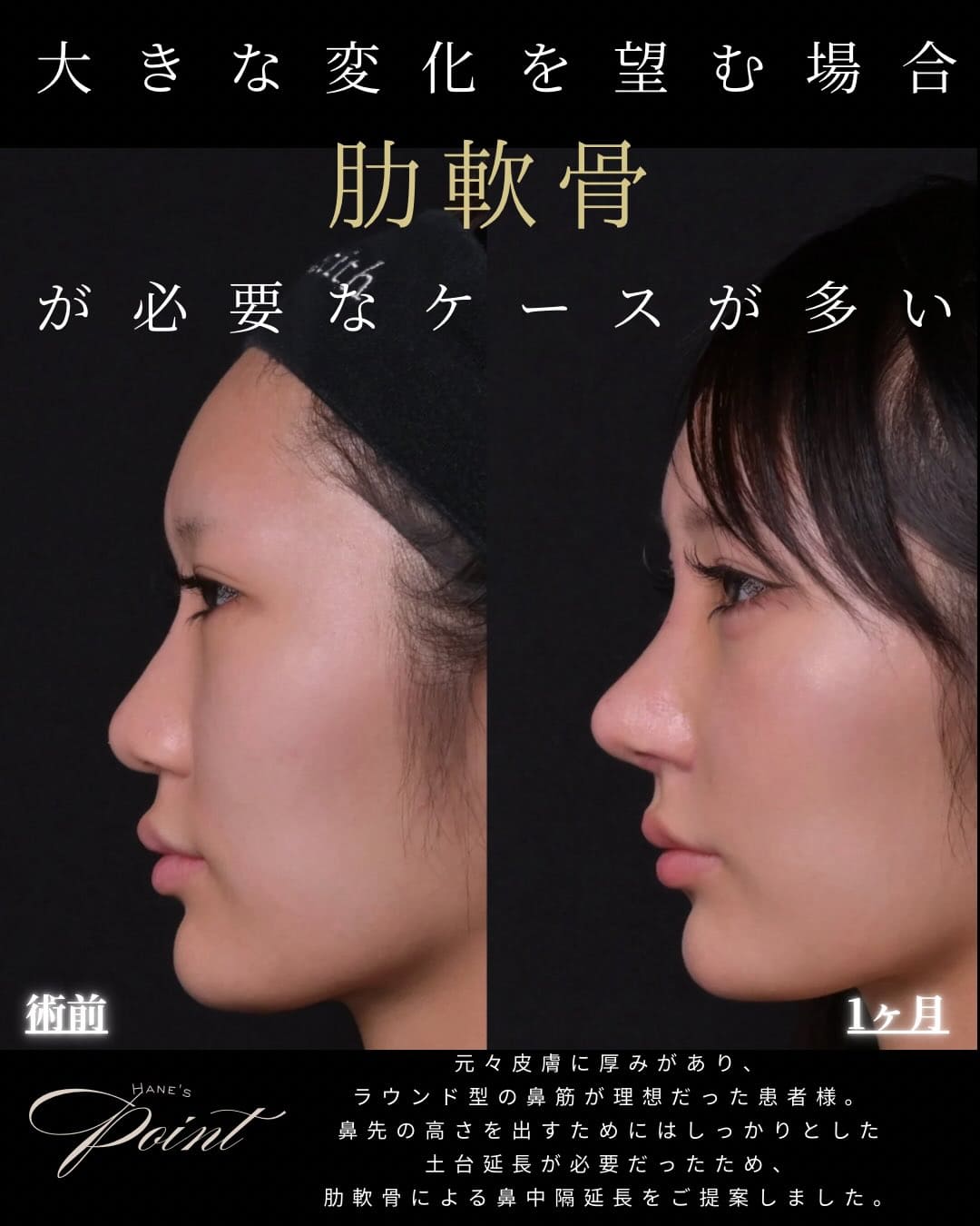 羽根医師による鼻整形の術前/術後1ヶ月 施術後 