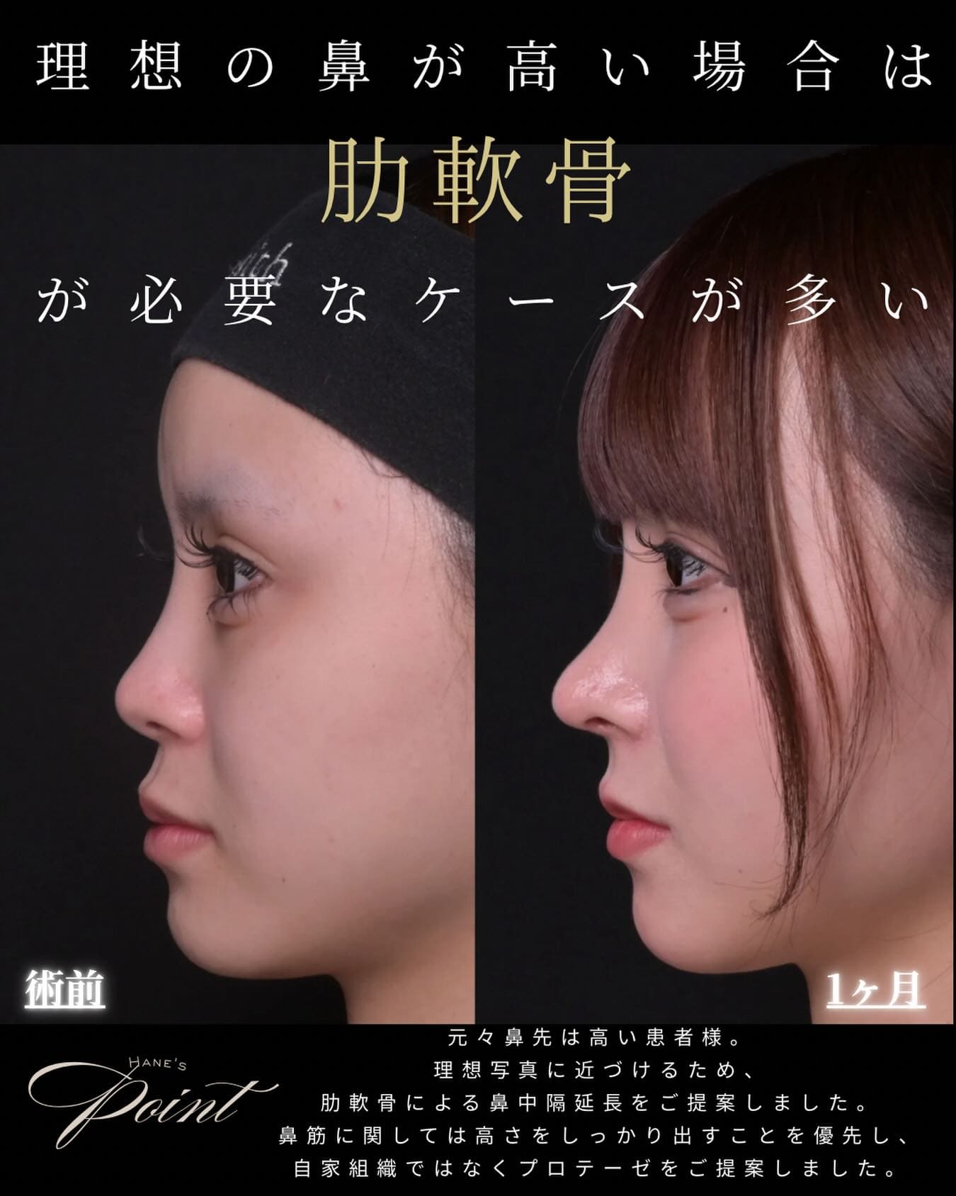 羽根医師による鼻整形の術前/術後1ヶ月 施術後 