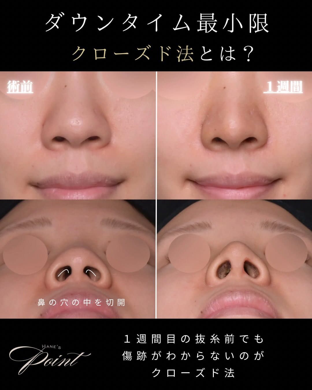 羽根医師による鼻整形の術前/術後1週間 术后 