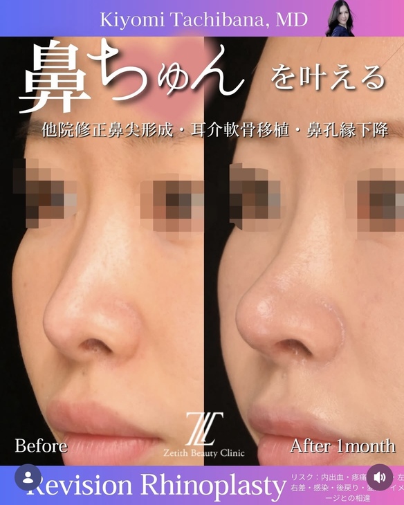 橘医師による鼻整形の術前/術後1ヶ月