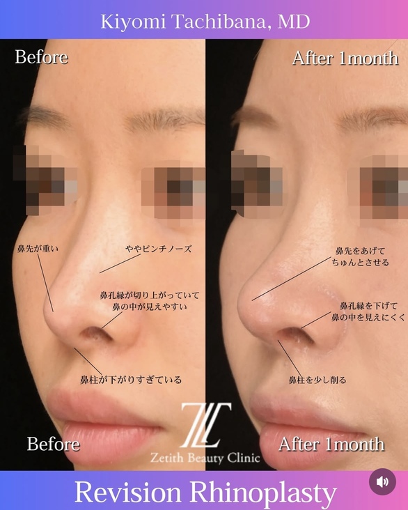 橘医師による鼻整形の術前/術後1ヶ月 施術後 